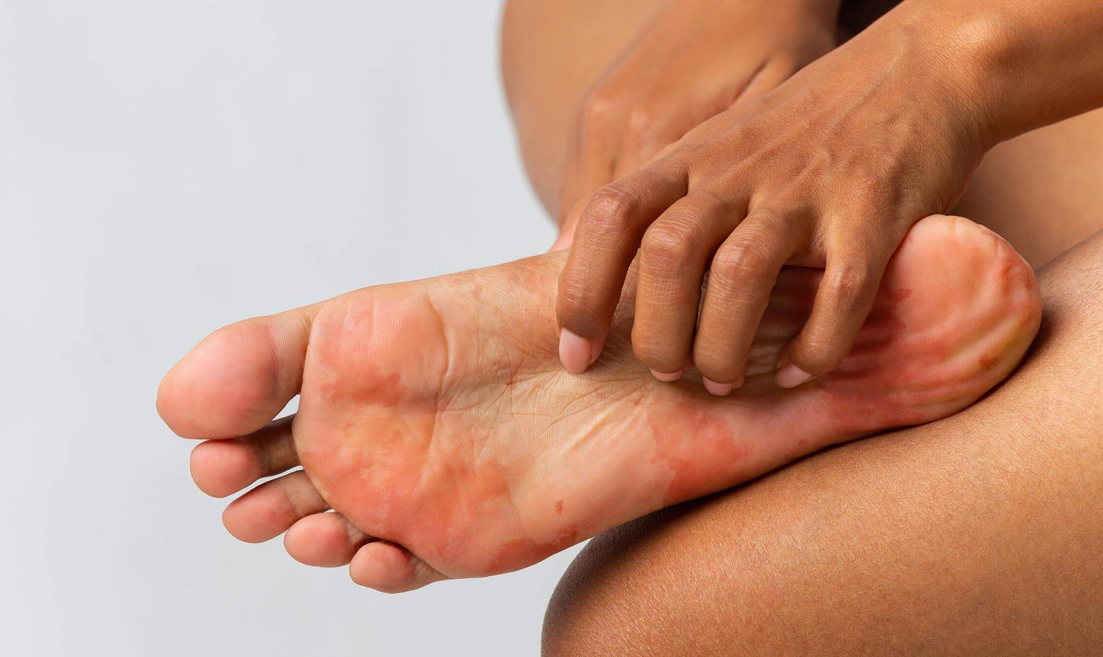 Juckende Fußsohlen – Das sind mögliche Ursachen