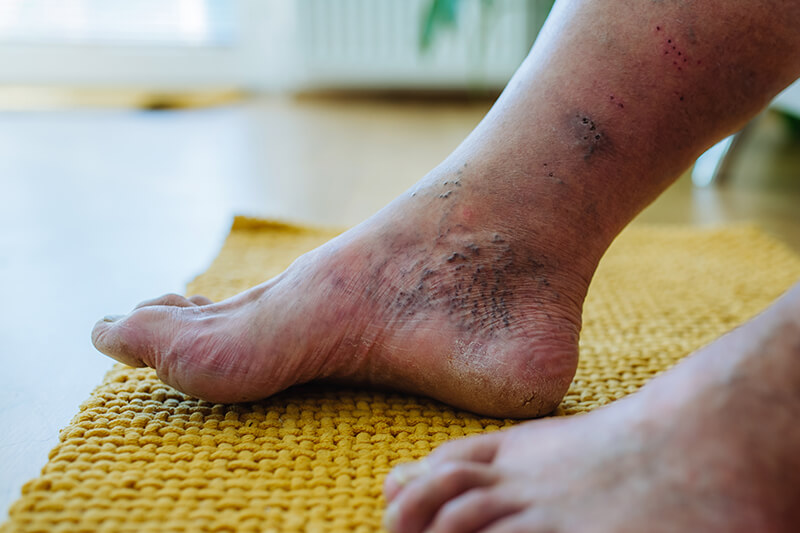 Die richtige Fußpflege für Diabetiker: Tipps für gesunde Füße